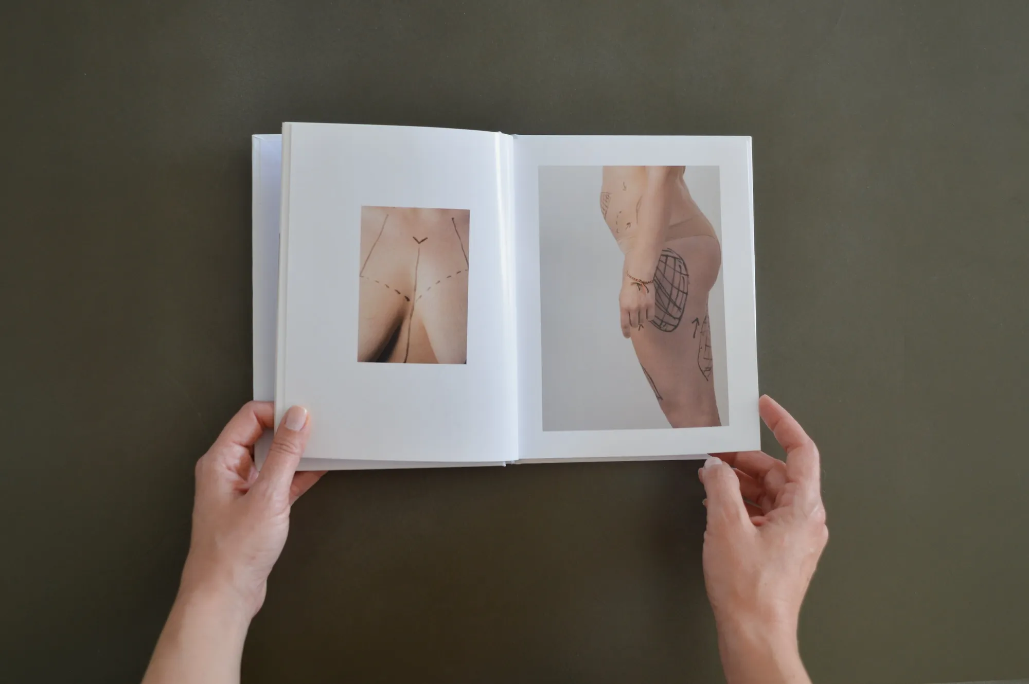 Book spread showing a close-up photograph of surgical marking lines on skin, alongside a larger photograph of a marked hip and thigh.