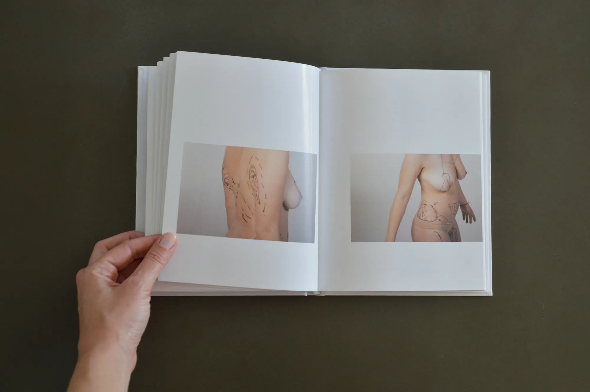 Two photographs of a body marked with aesthetic surgeon's drawings, side and front views.